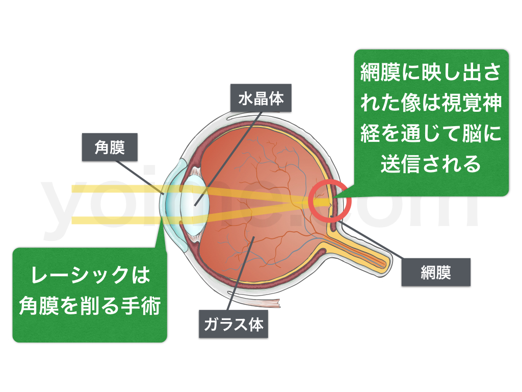 レーシックは角膜を削る手術。網膜に映し出された像は視神経を通じて脳に送信される