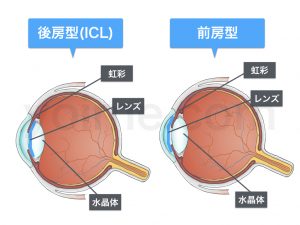 フェイキックIOLの概要図